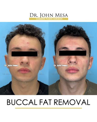 Buccal Fat Pad Removal for Men Before & After Gallery - Patient 149097953 - Image 1