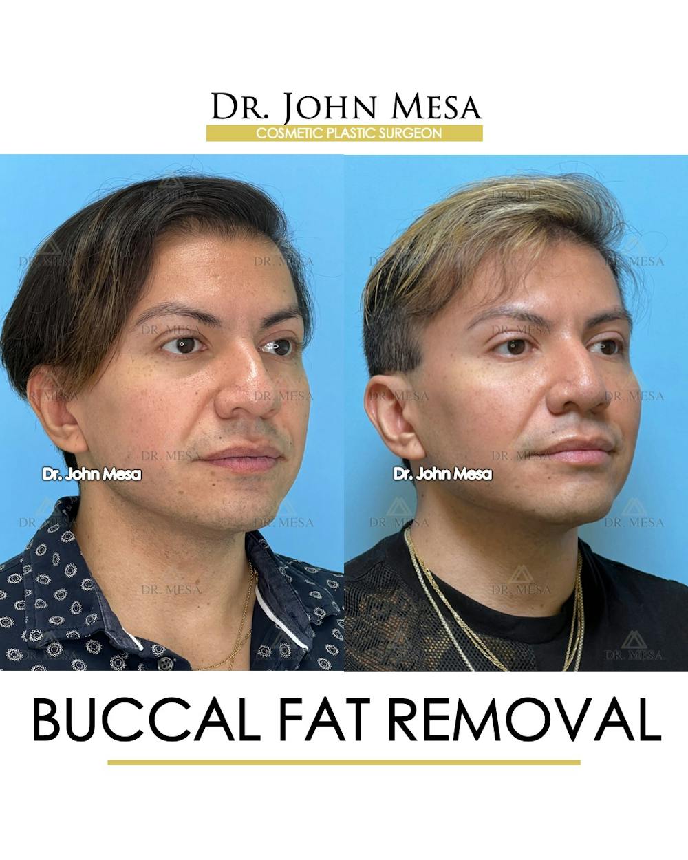 Buccal Fat Pad Removal for Men Before & After Gallery - Patient 149097952 - Image 2