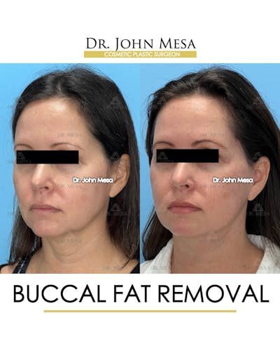 Buccal Fat Pad Removal Before & After Gallery - Patient 149097944 - Image 4