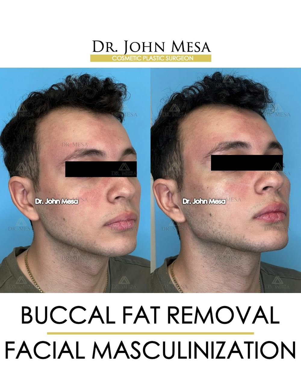 Facial Masculinization Before & After Gallery - Patient 149097993 - Image 2