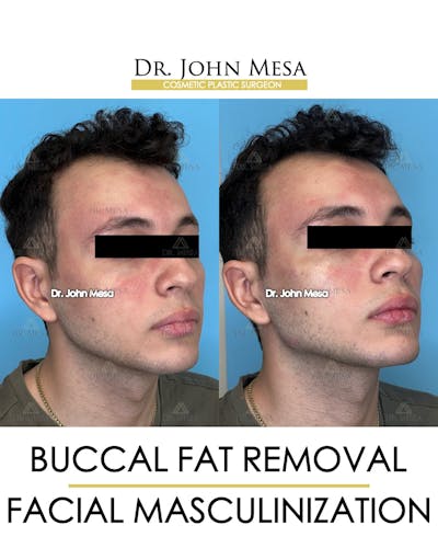 Facial Masculinization Before & After Gallery - Patient 149097993 - Image 2