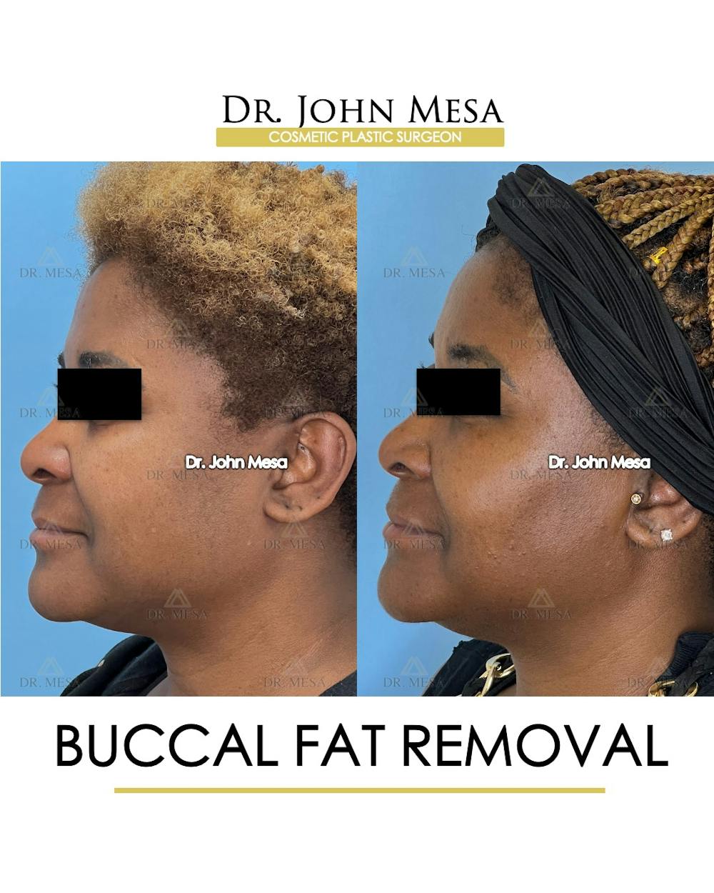 Buccal Fat Pad Removal Before & After Gallery - Patient 149097949 - Image 5