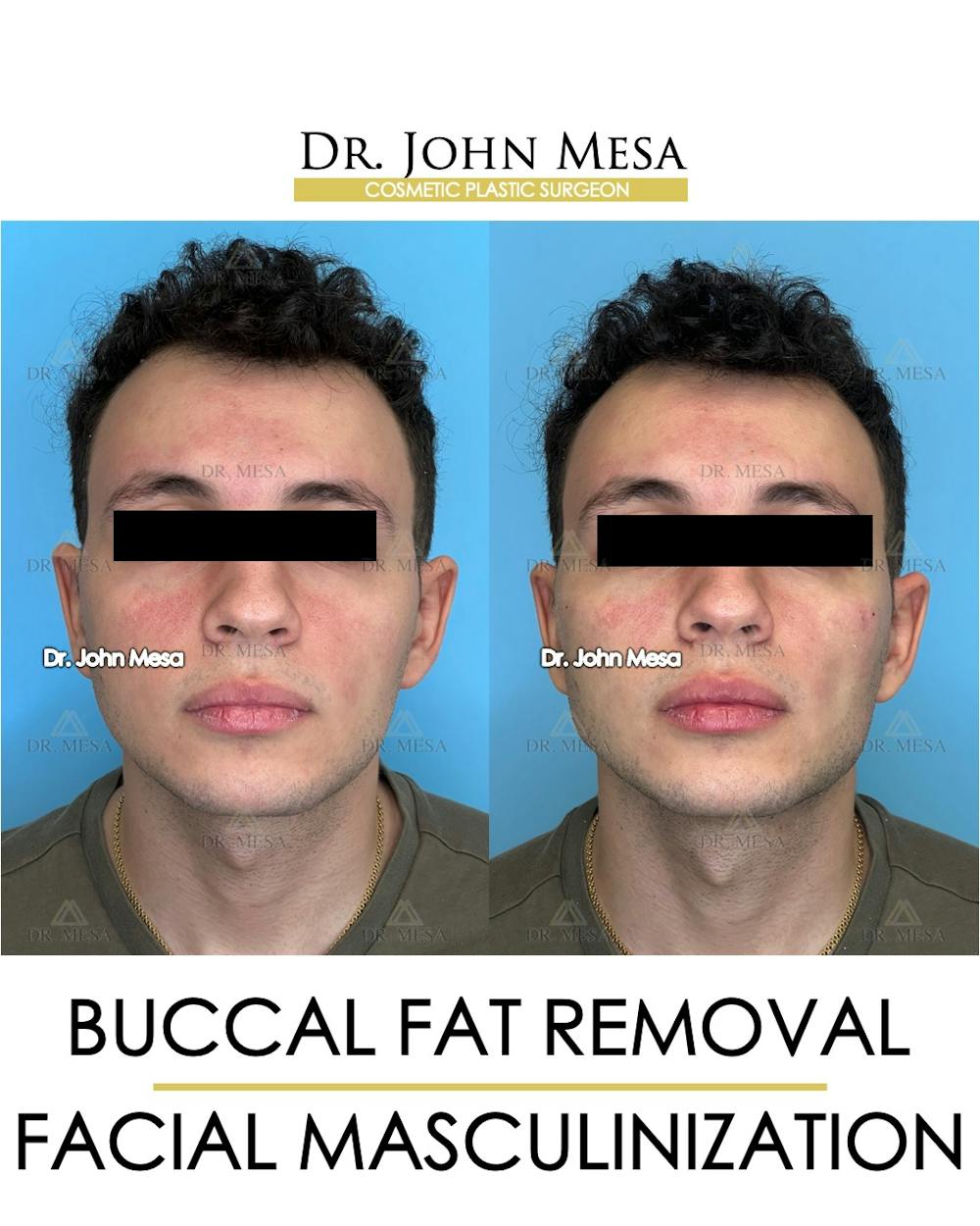 Buccal Fat Pad Removal for Men Before & After Gallery - Patient 149097951 - Image 1