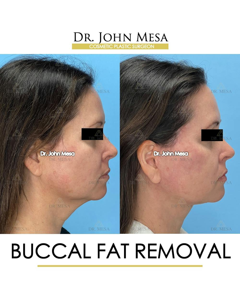 Buccal Fat Pad Removal Before & After Gallery - Patient 149097944 - Image 3