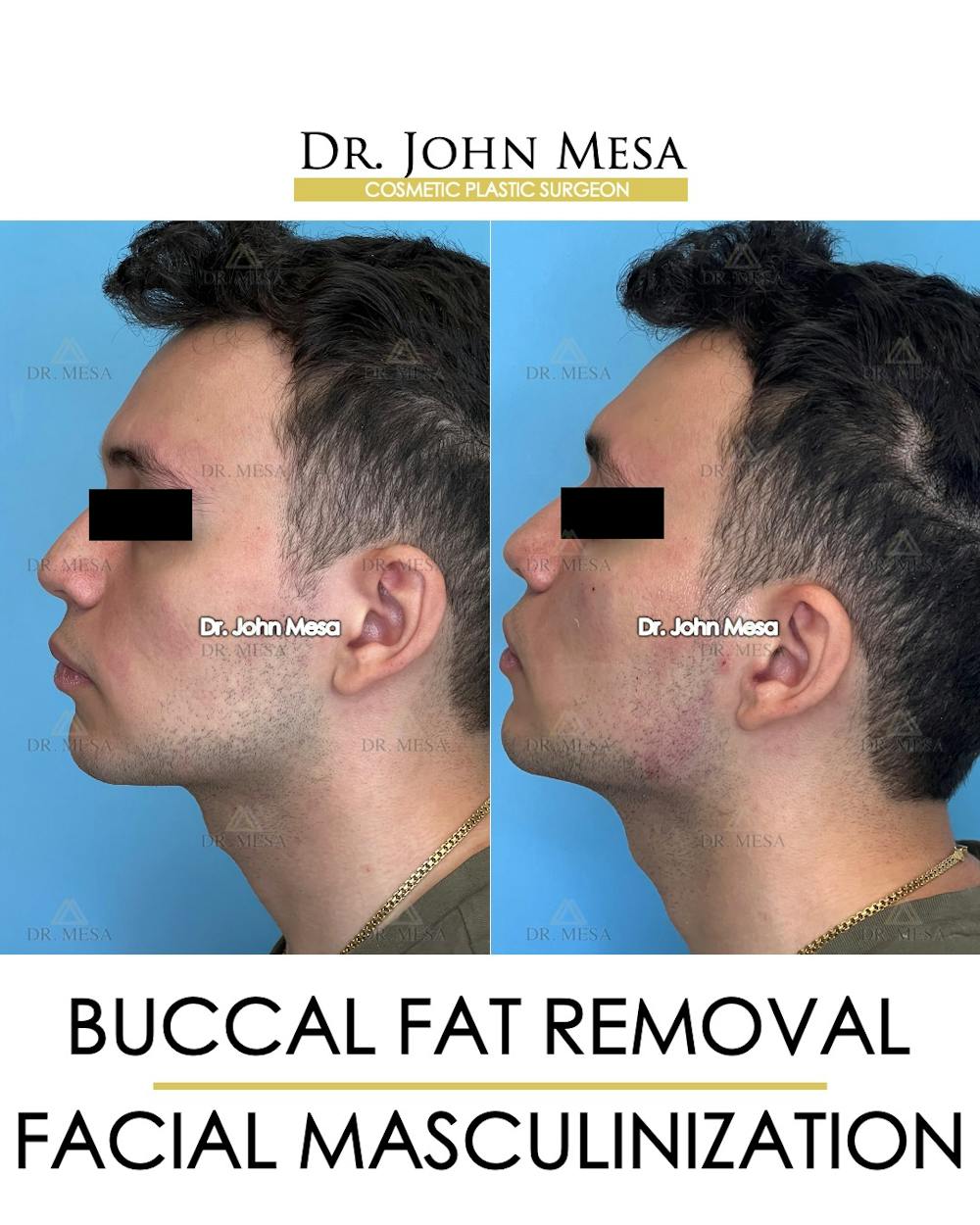 Buccal Fat Pad Removal for Men Before & After Gallery - Patient 149097951 - Image 5
