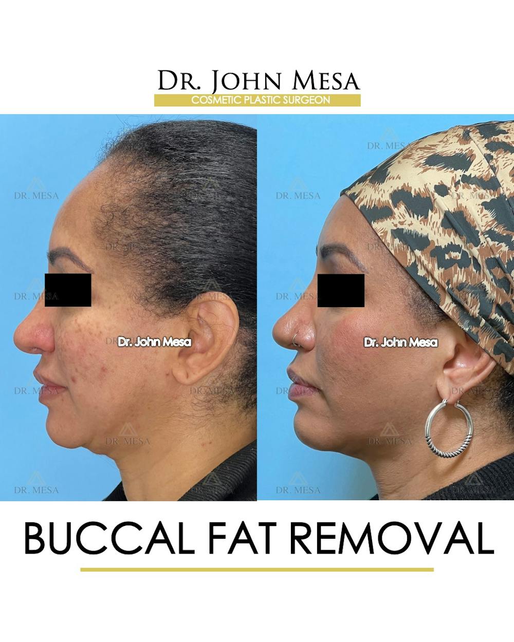 Buccal Fat Pad Removal Before & After Gallery - Patient 149097948 - Image 5