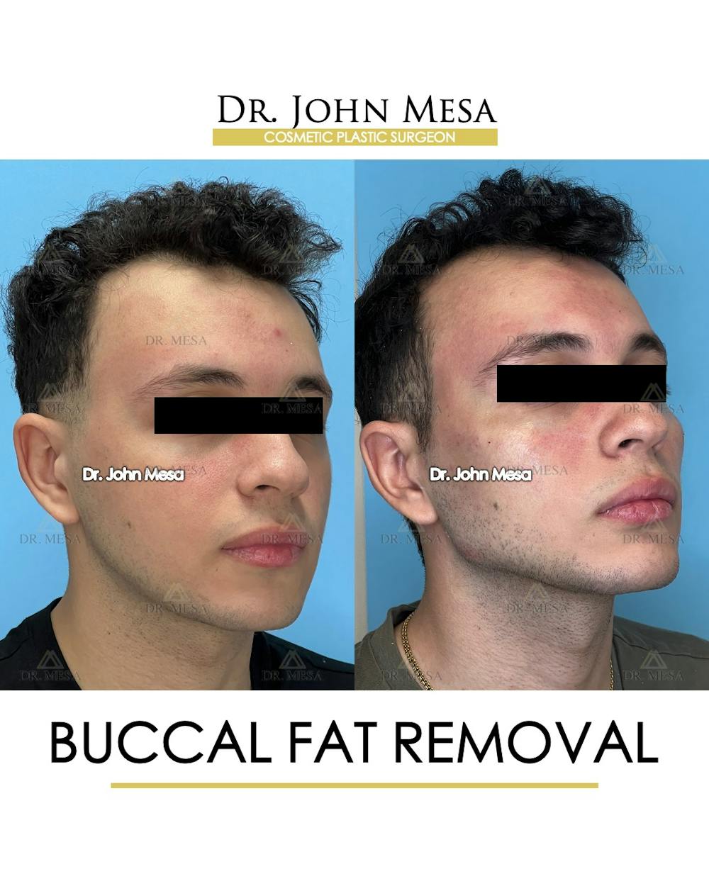 Buccal Fat Pad Removal for Men Before & After Gallery - Patient 149097953 - Image 2