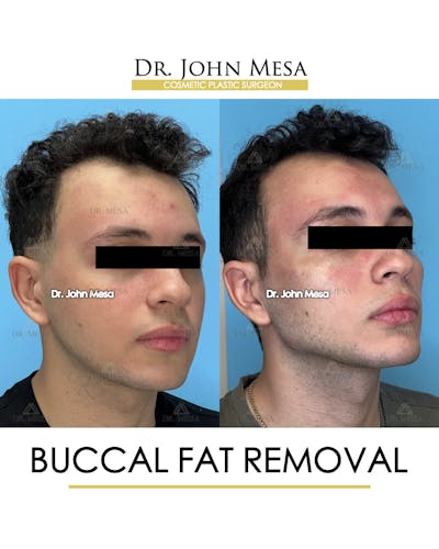 Buccal Fat Pad Removal for Men Before & After Gallery - Patient 149097953 - Image 2
