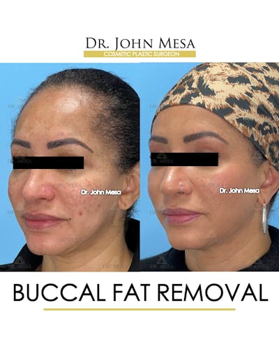 Buccal Fat Pad Removal Before & After Gallery - Patient 149097948 - Image 4