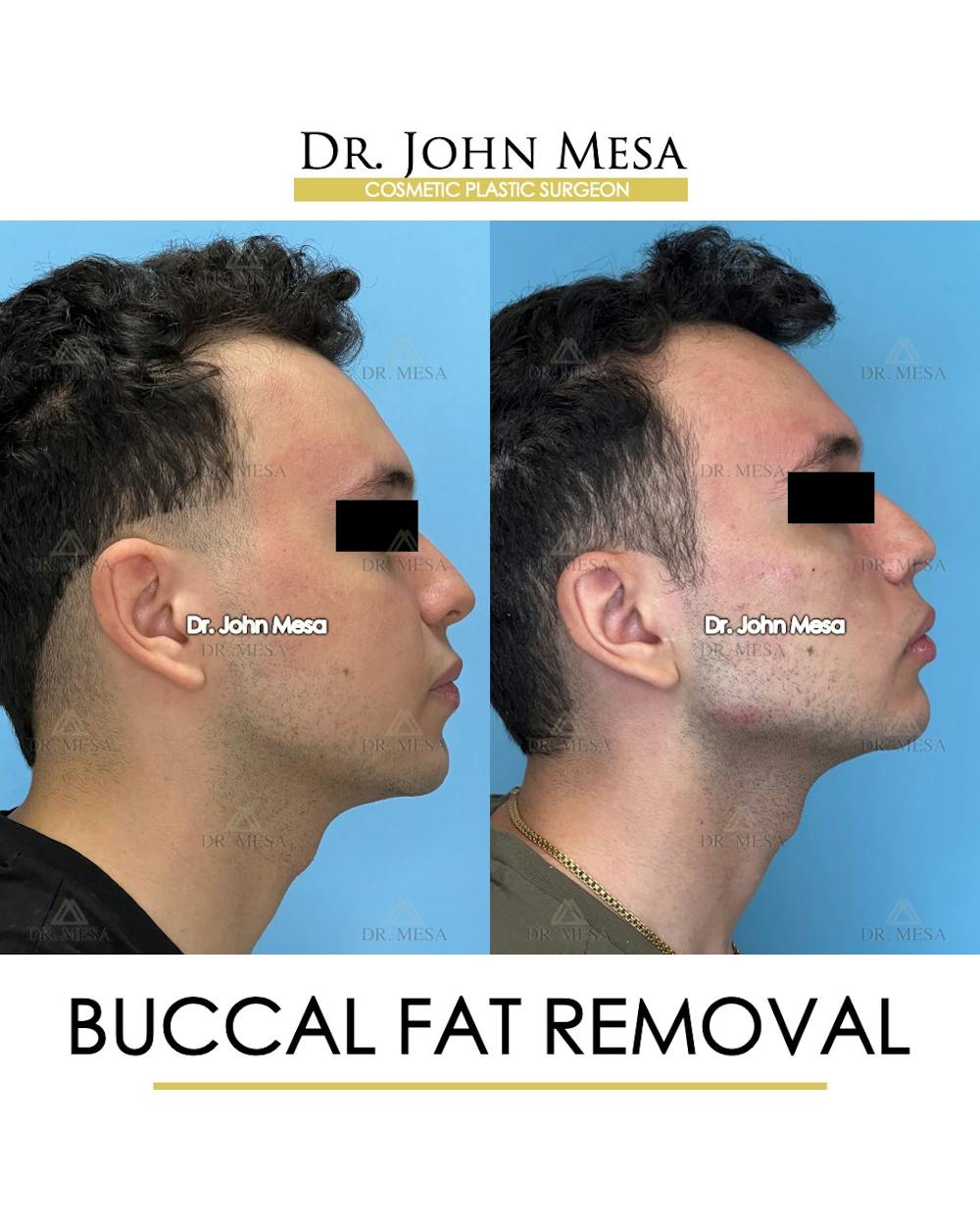 Buccal Fat Pad Removal for Men Before & After Gallery - Patient 149097953 - Image 3