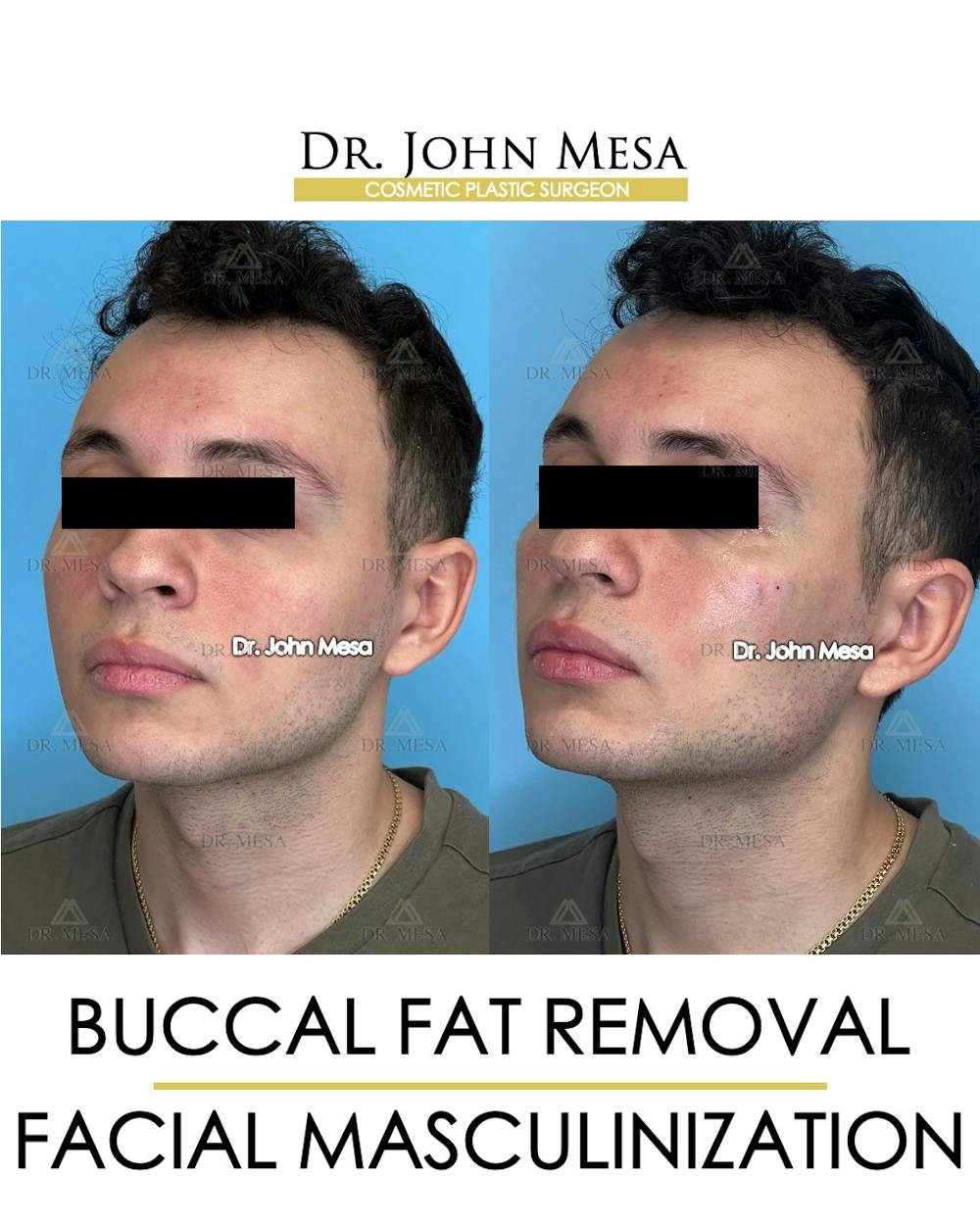 Facial Masculinization Before & After Gallery - Patient 149097993 - Image 4