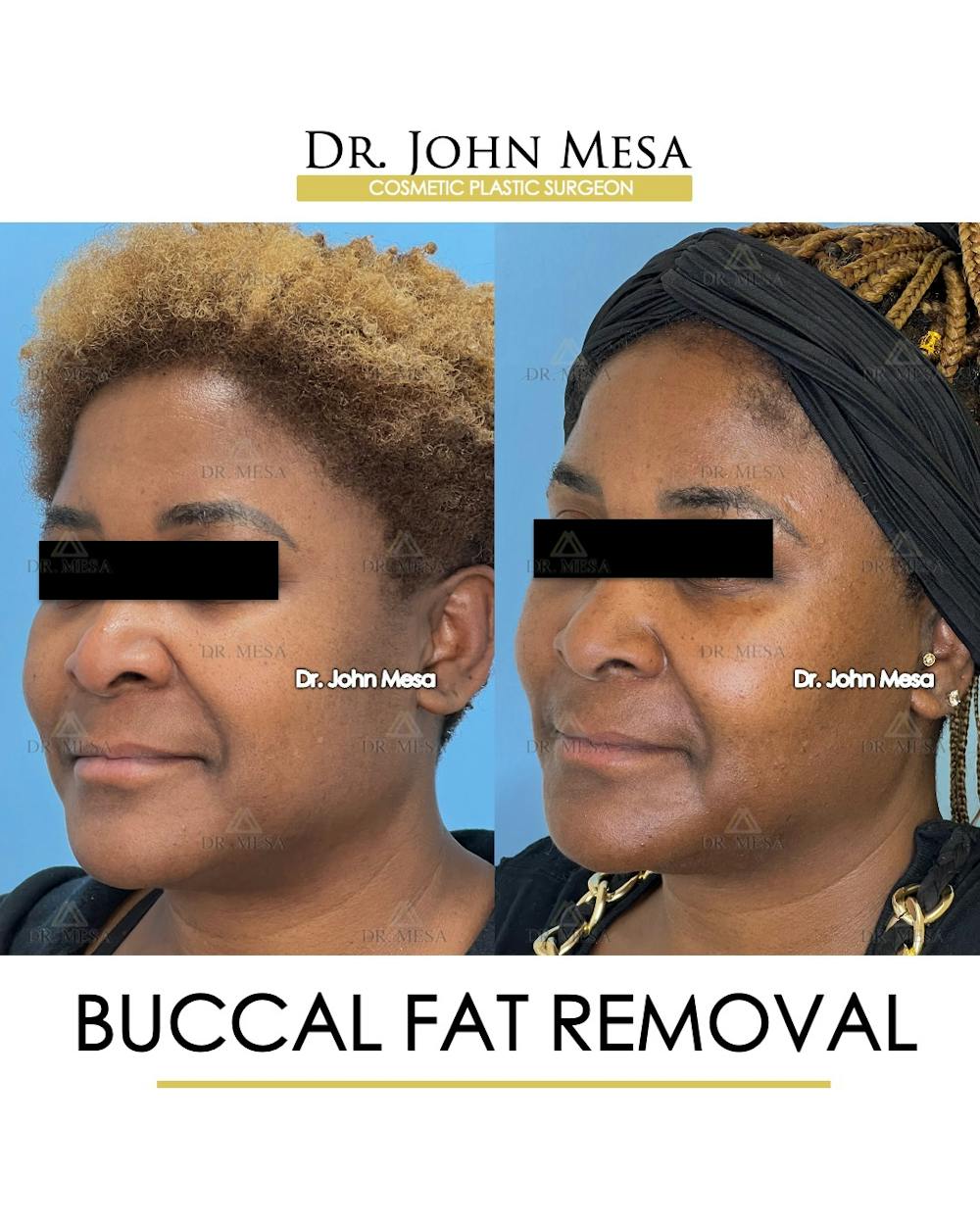 Buccal Fat Pad Removal Before & After Gallery - Patient 149097949 - Image 4