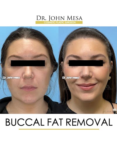 Buccal Fat Pad Removal Before & After Gallery - Patient 149097945 - Image 1