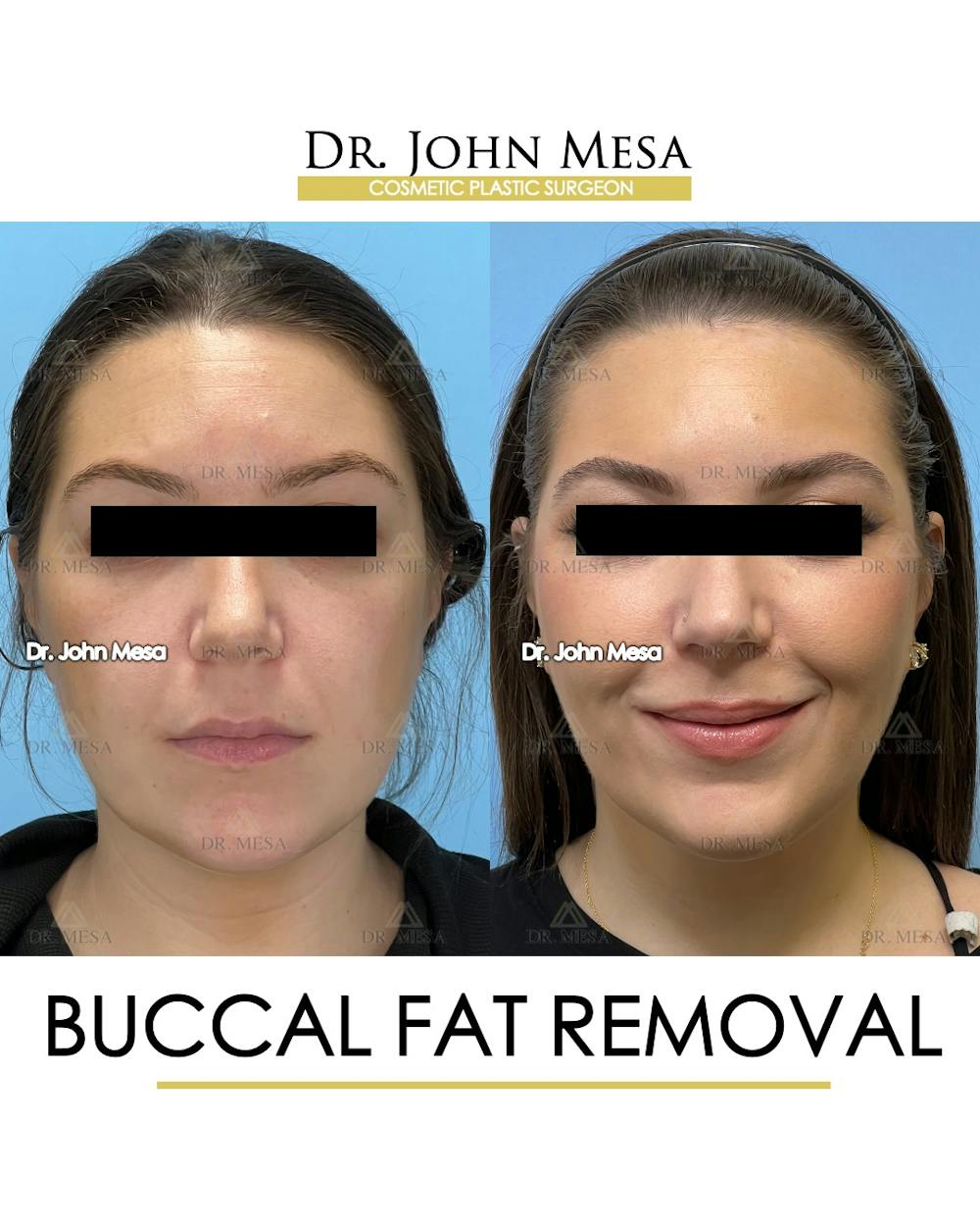 Buccal Fat Pad Removal Before & After Gallery - Patient 149097945 - Image 1