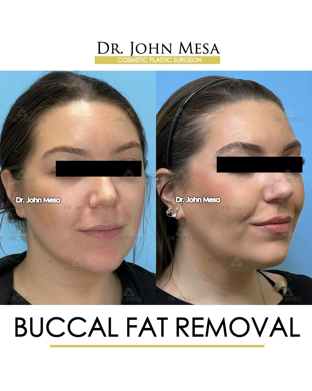 Buccal Fat Pad Removal Before & After Gallery - Patient 149097945 - Image 2