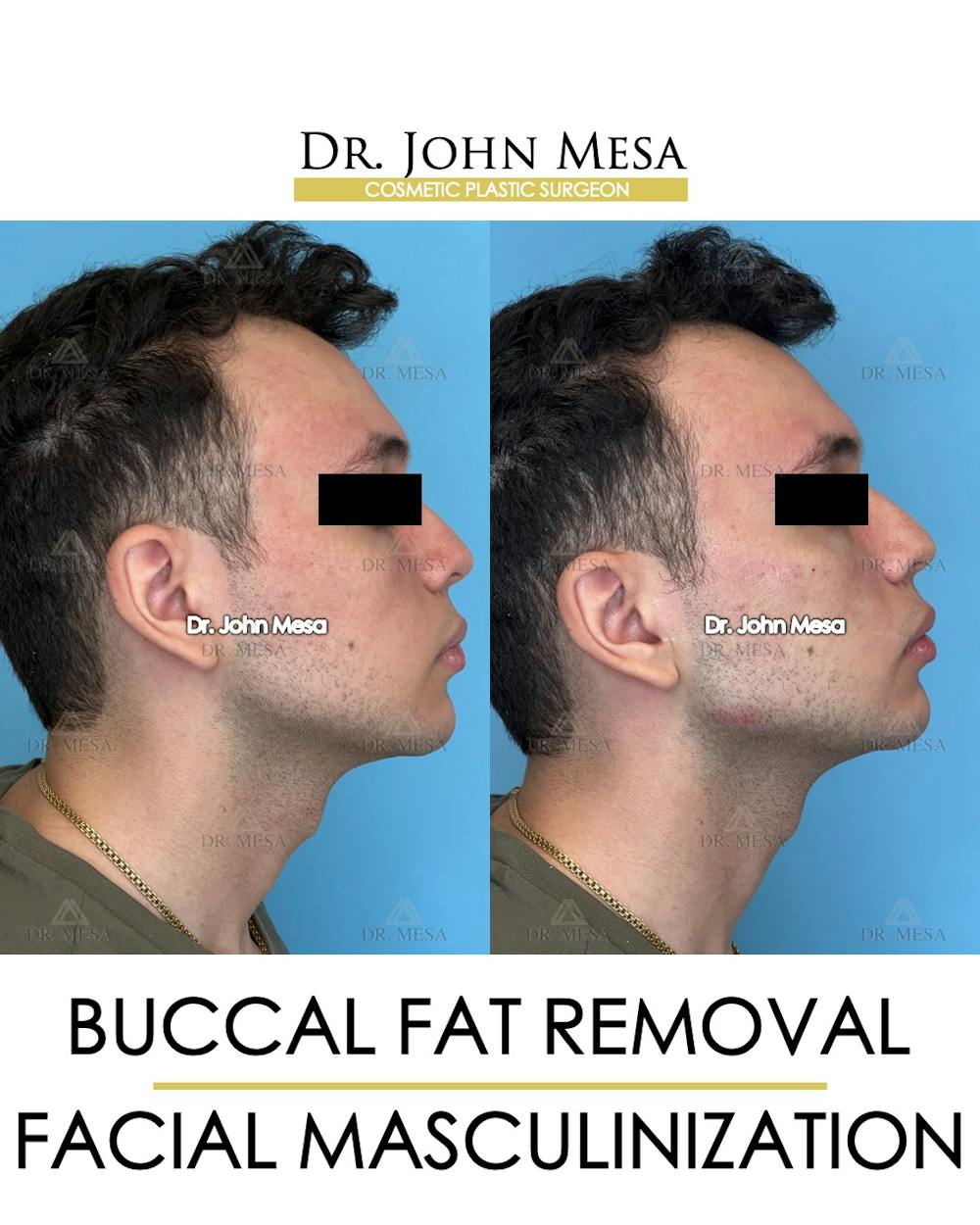 Buccal Fat Pad Removal for Men Before & After Gallery - Patient 149097951 - Image 3