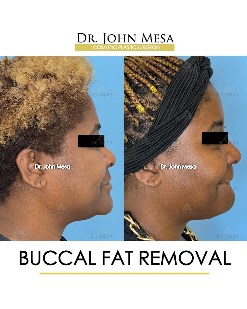 Buccal Fat Pad Removal Before & After Gallery - Patient 149097949 - Image 3