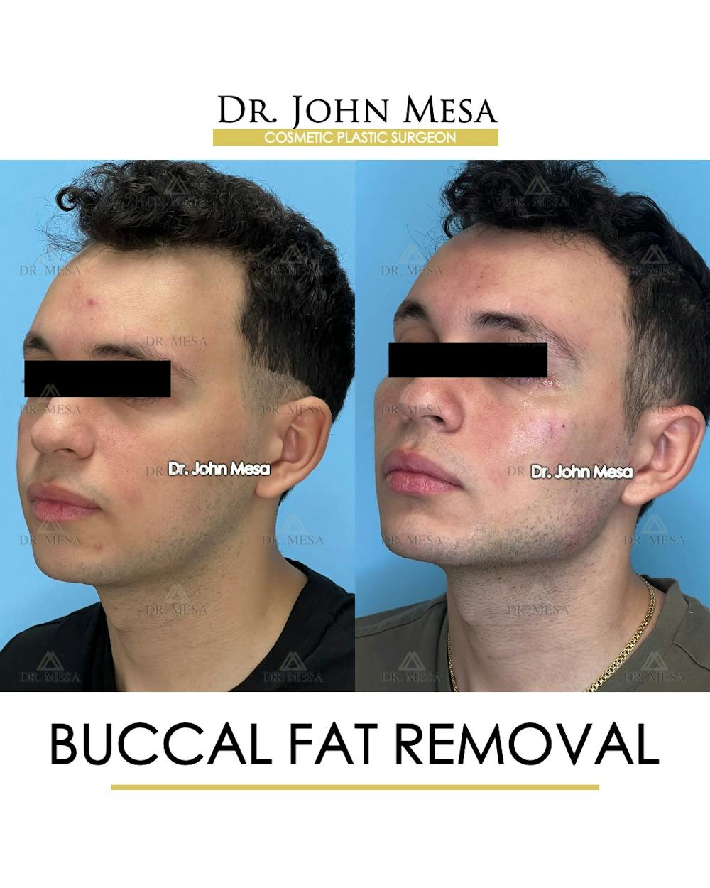 Buccal Fat Pad Removal for Men Before & After Gallery - Patient 149097953 - Image 4