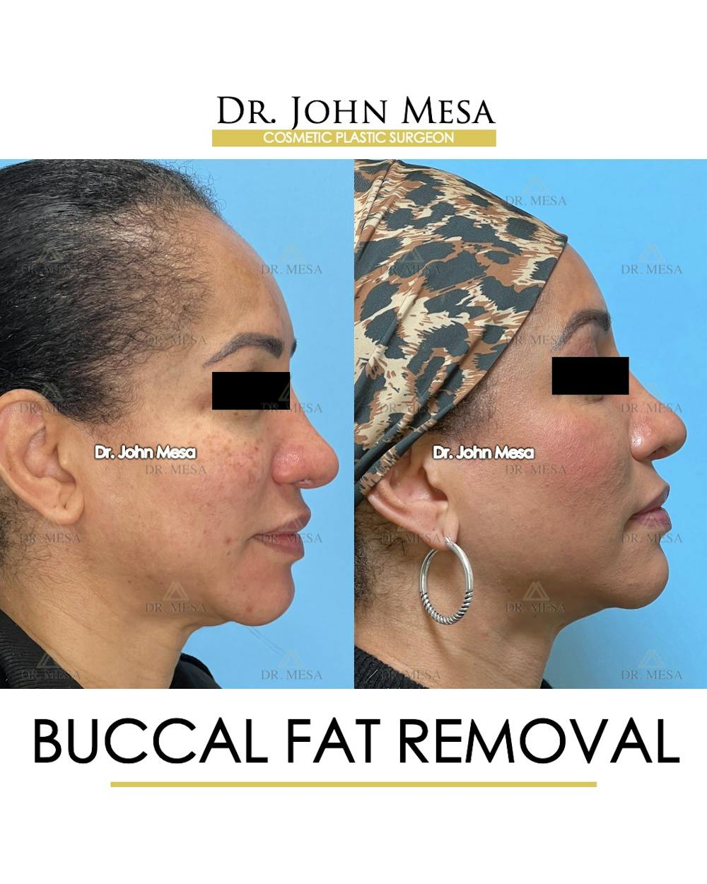 Buccal Fat Pad Removal Before & After Gallery - Patient 149097948 - Image 3