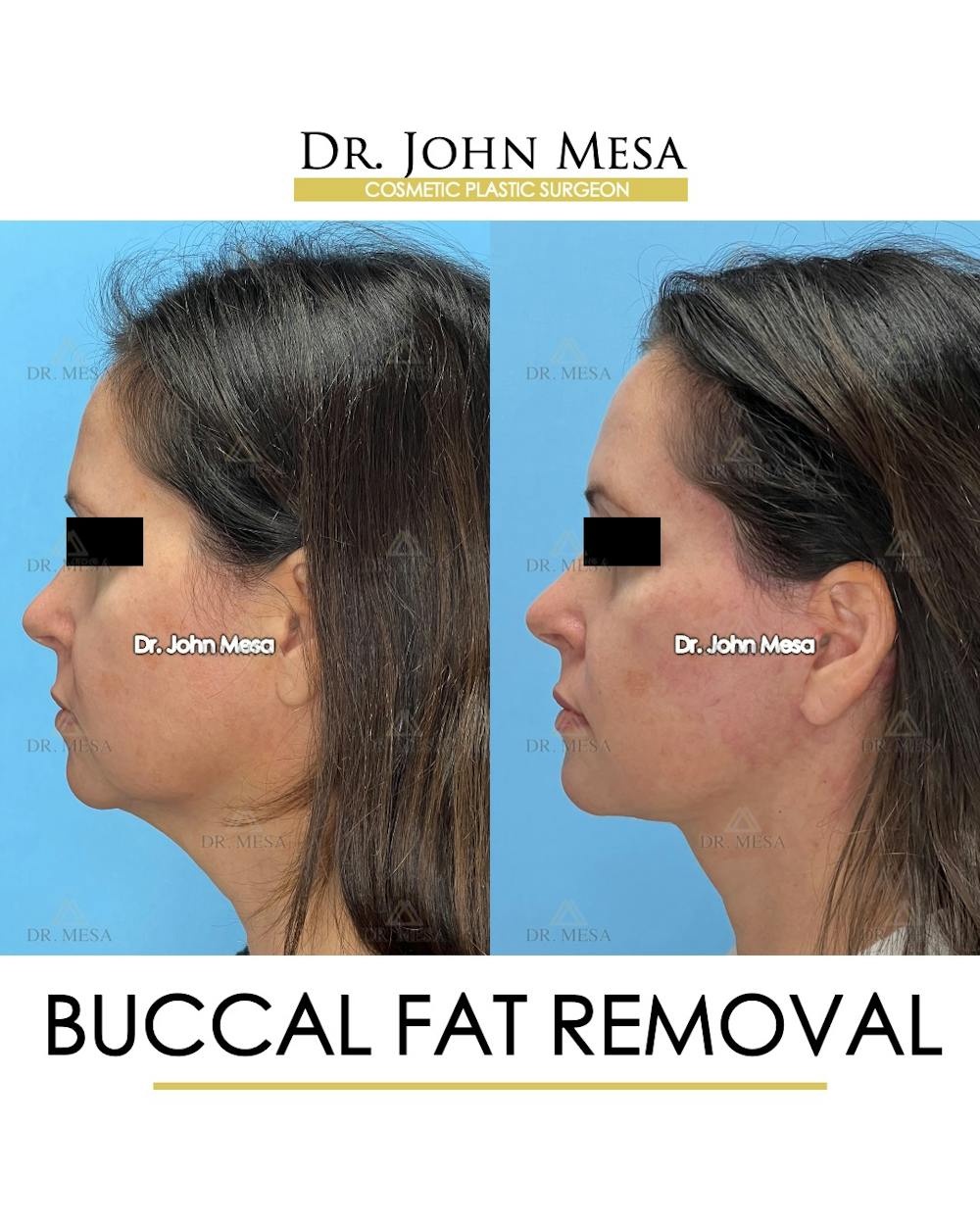 Buccal Fat Pad Removal Before & After Gallery - Patient 149097944 - Image 5