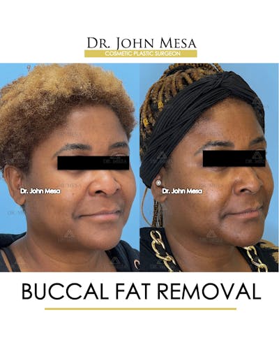 Buccal Fat Pad Removal Before & After Gallery - Patient 149097949 - Image 2