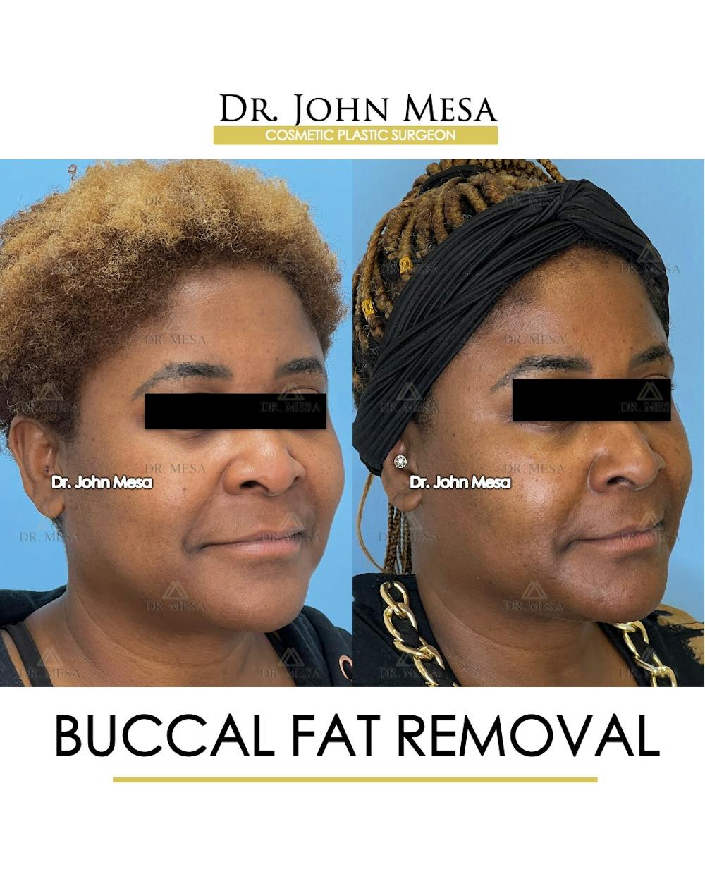 Buccal Fat Pad Removal Before & After Gallery - Patient 149097949 - Image 2