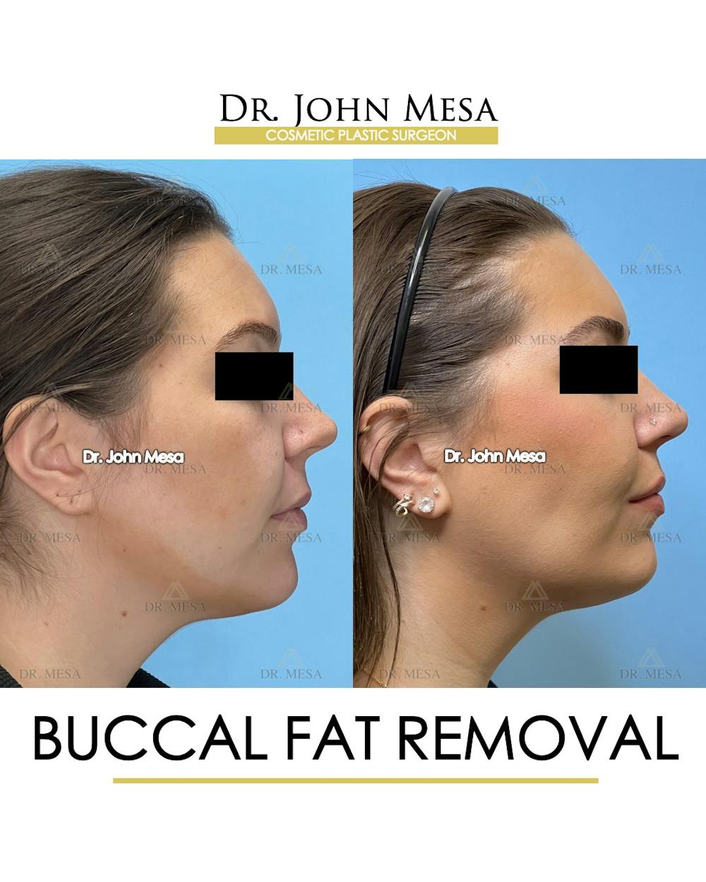 Buccal Fat Pad Removal Before & After Gallery - Patient 149097945 - Image 3