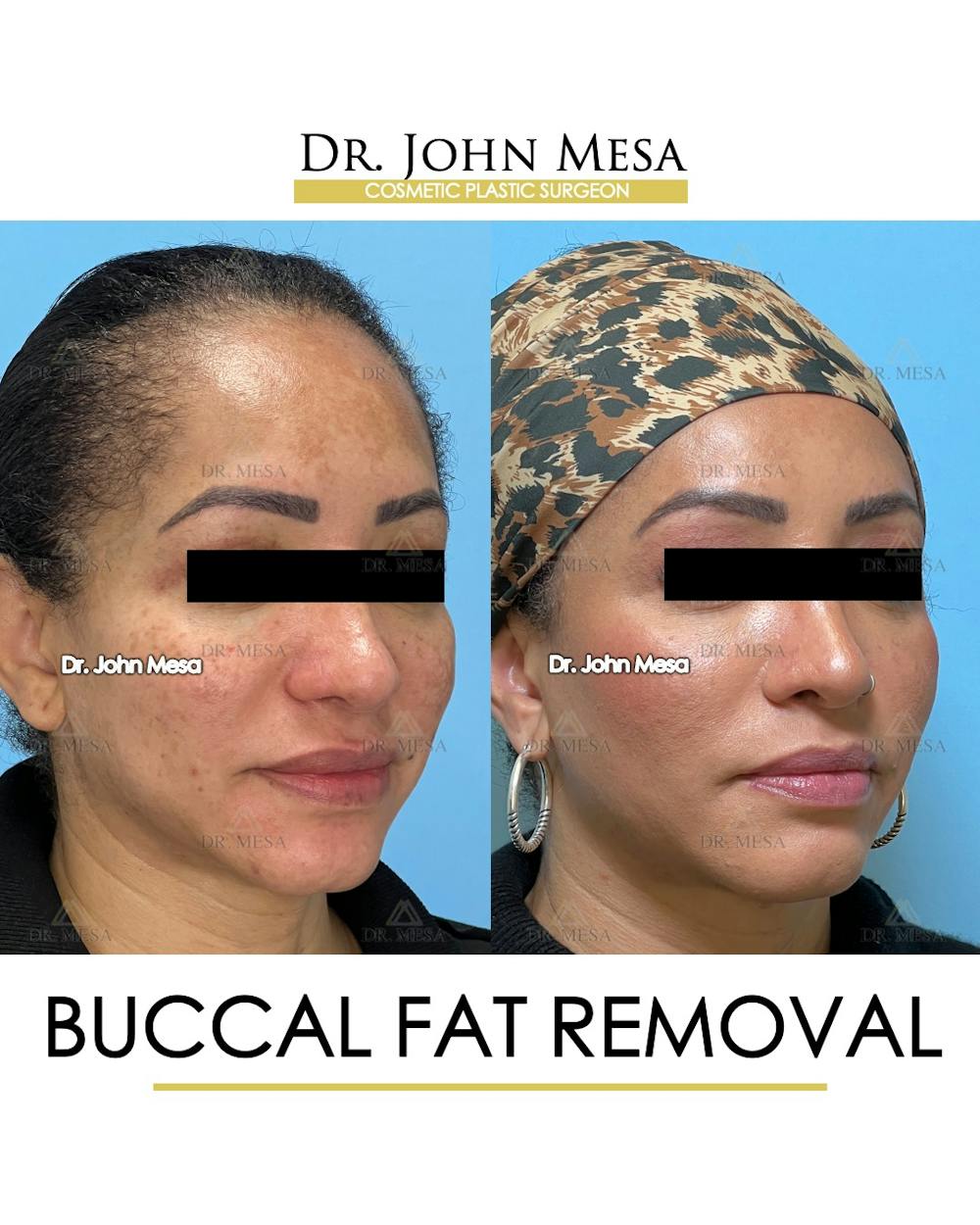 Buccal Fat Pad Removal Before & After Gallery - Patient 149097948 - Image 2