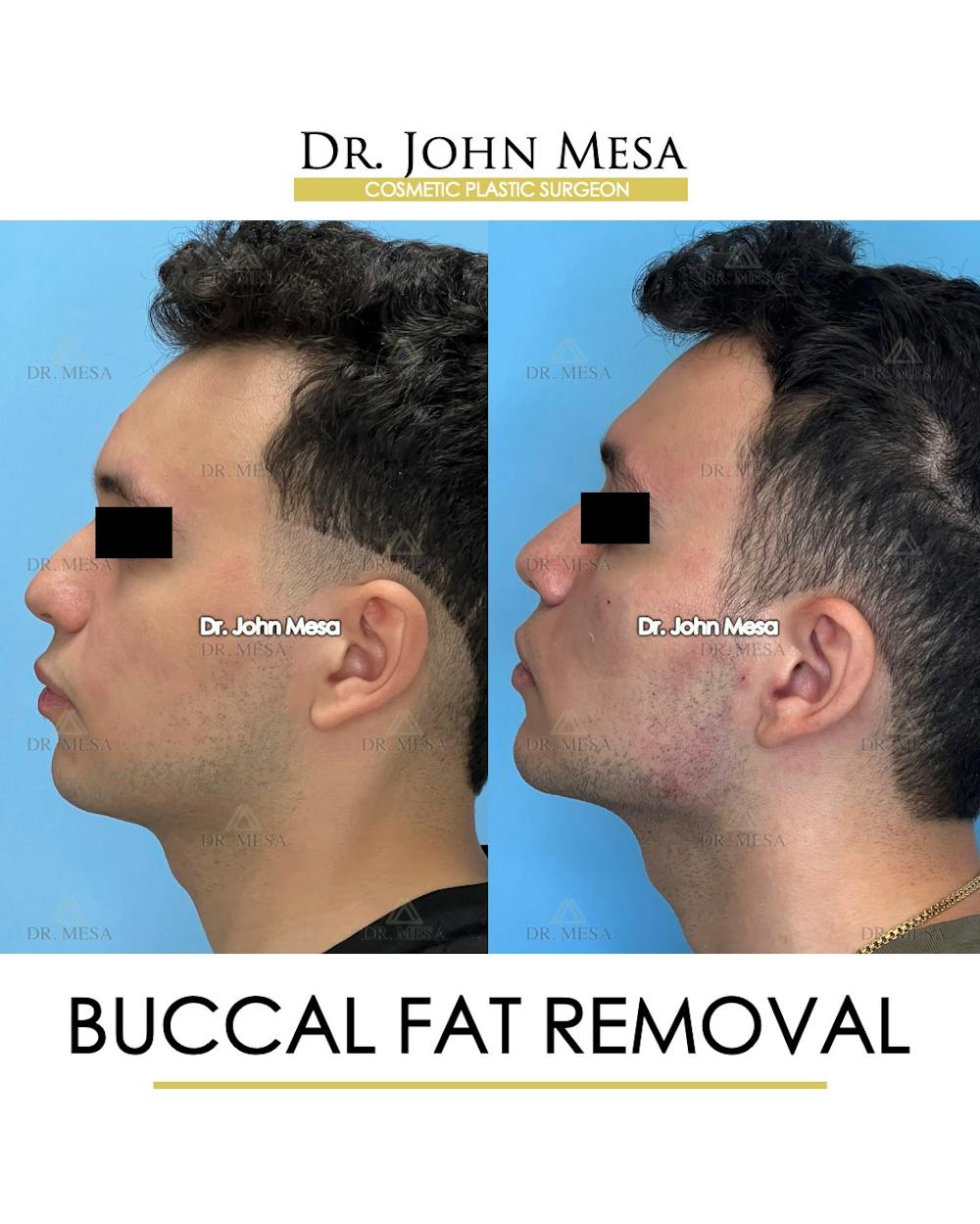 Buccal Fat Pad Removal for Men Before & After Gallery - Patient 149097953 - Image 5