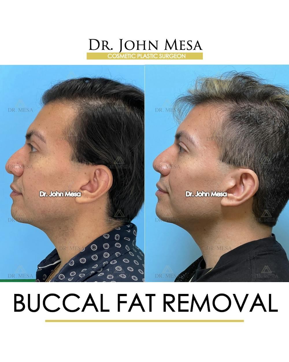 Buccal Fat Pad Removal for Men Before & After Gallery - Patient 149097952 - Image 5