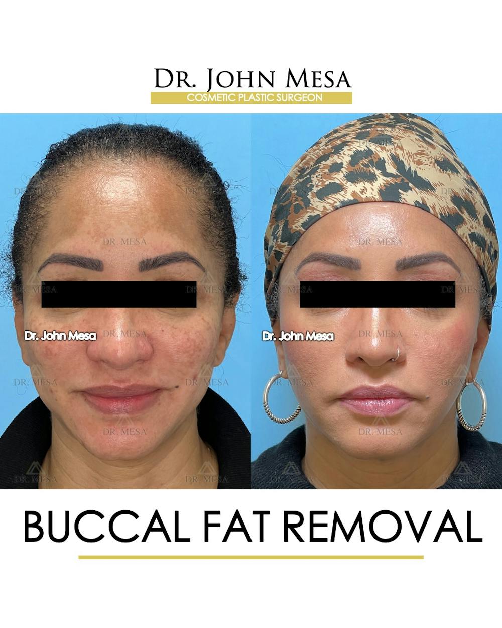 Buccal Fat Pad Removal Before & After Gallery - Patient 149097948 - Image 1