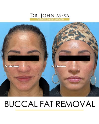 Buccal Fat Pad Removal Before & After Gallery - Patient 149097948 - Image 1