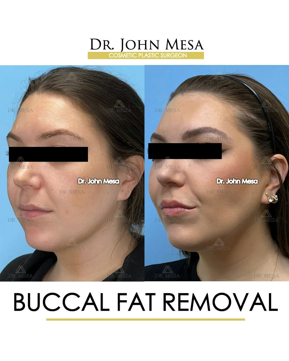 Buccal Fat Pad Removal Before & After Gallery - Patient 149097945 - Image 4