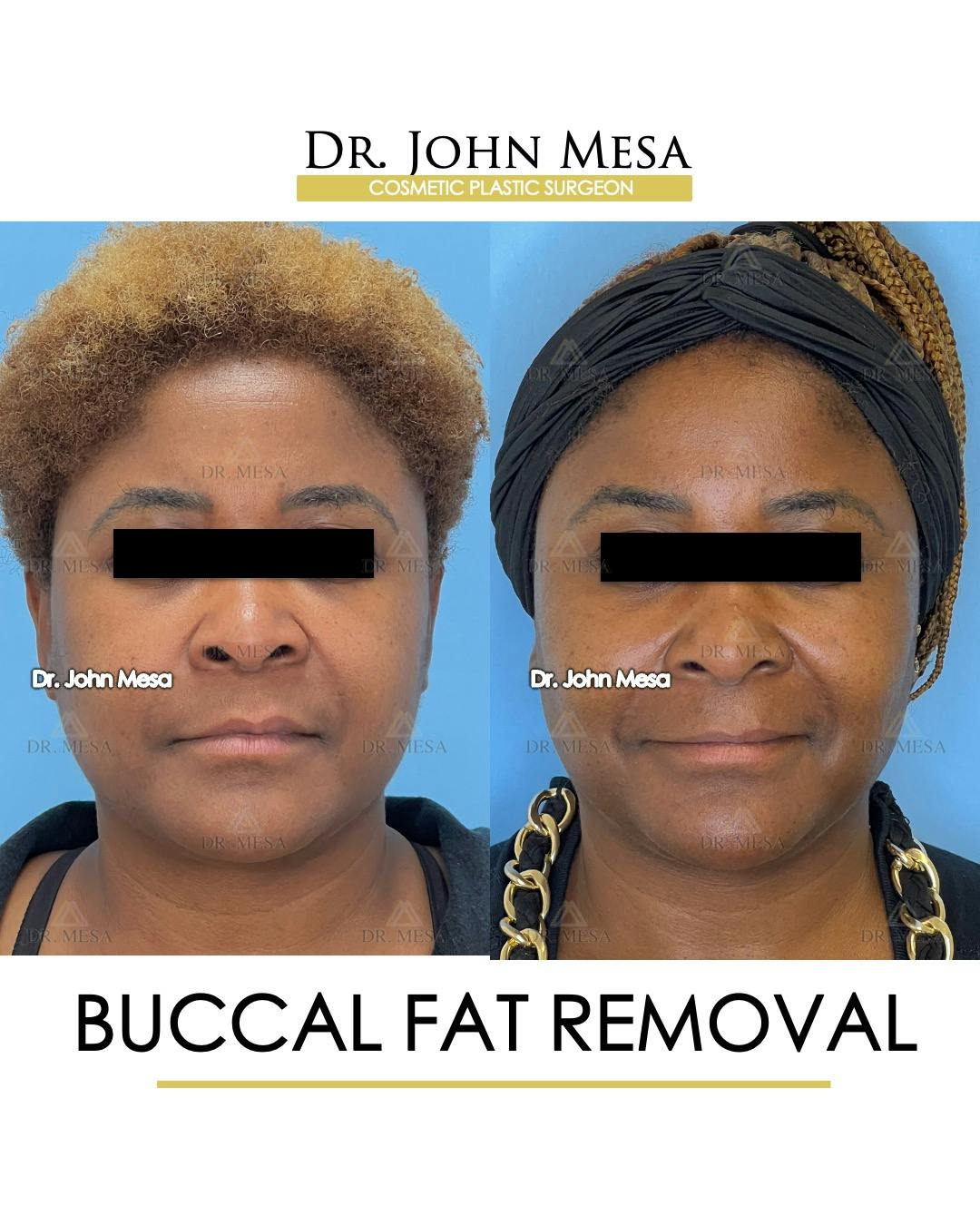 Buccal Fat Pad Removal Gallery