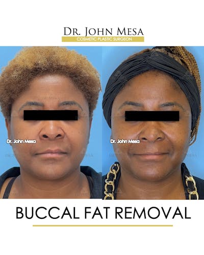 Buccal Fat Pad Removal Before & After Gallery - Patient 149097949 - Image 1