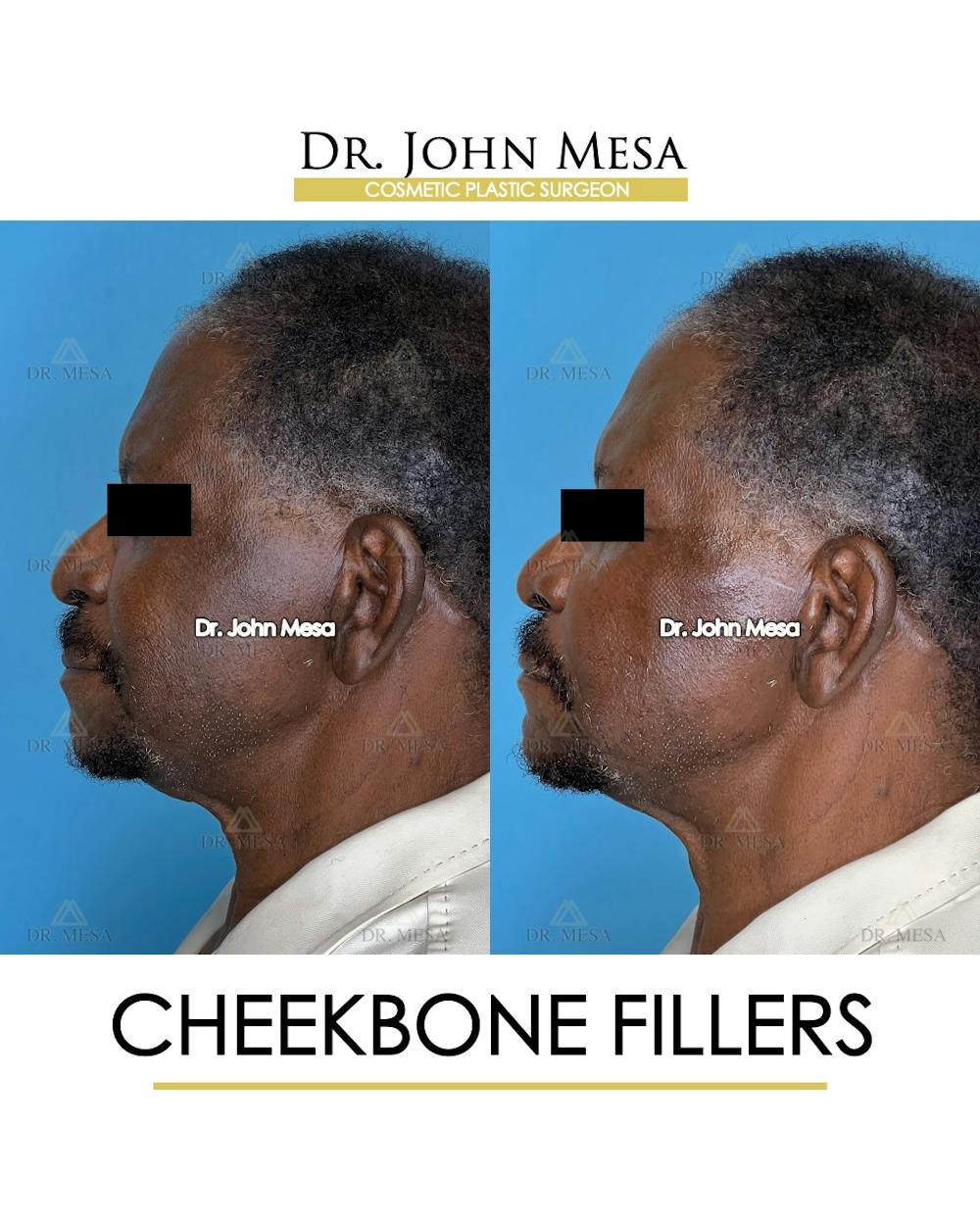Cheekbone Filler Before & After Gallery - Patient 149097959 - Image 5
