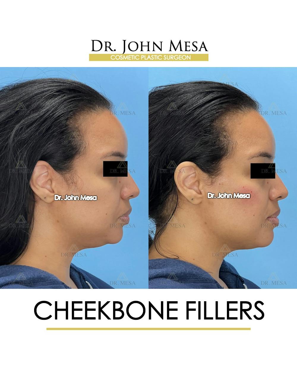 Cheekbone Filler Before & After Gallery - Patient 149097955 - Image 3