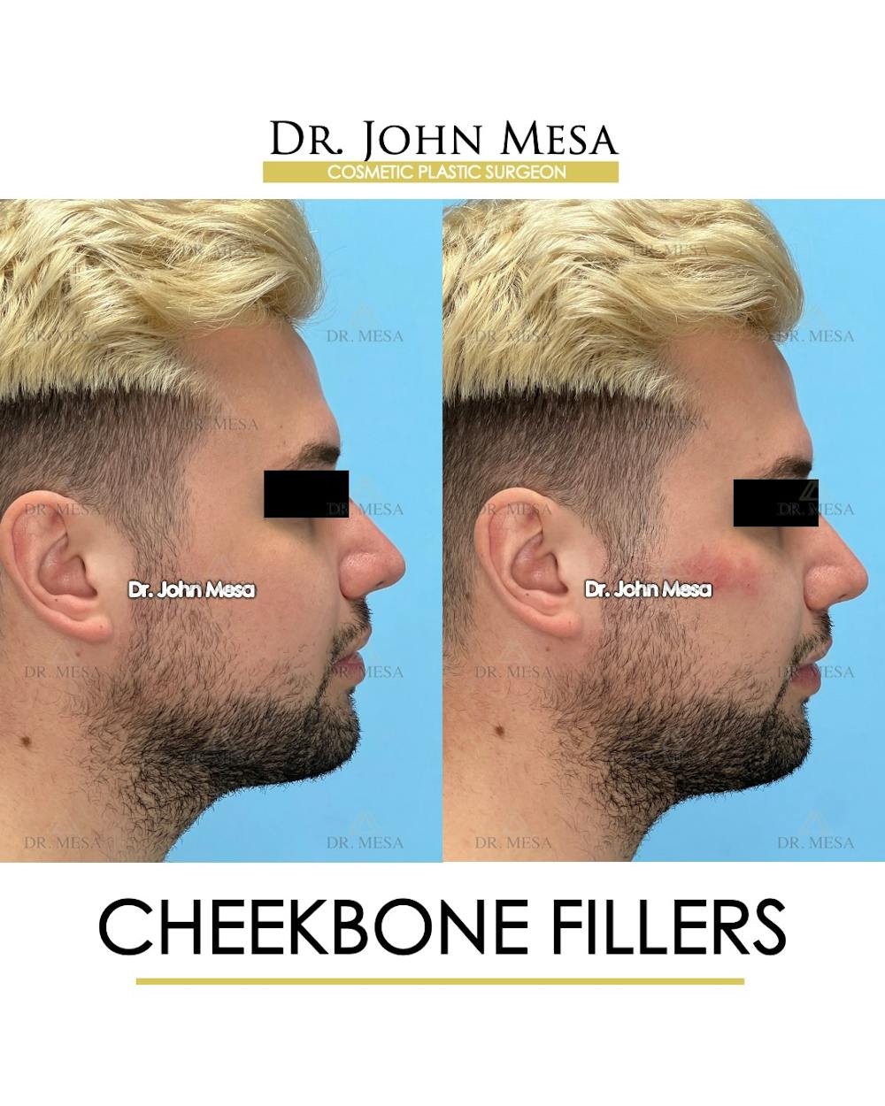 Cheekbone Filler Before & After Gallery - Patient 149097960 - Image 3