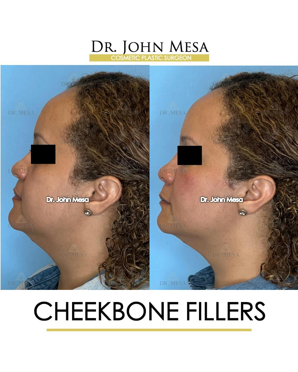 Cheekbone Filler Before & After Gallery - Patient 149097954 - Image 5
