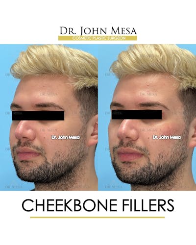 Cheekbone Filler Before & After Gallery - Patient 149097960 - Image 4