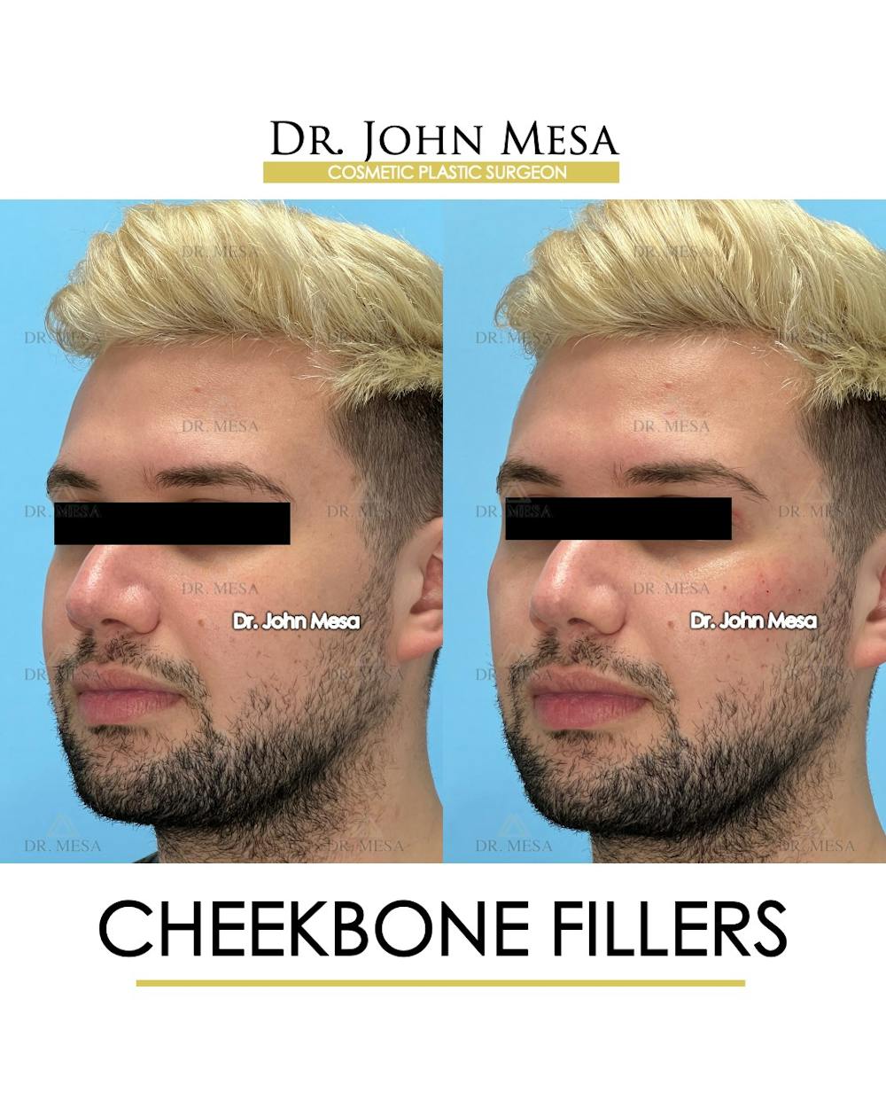 Cheekbone Filler Before & After Gallery - Patient 149097960 - Image 4