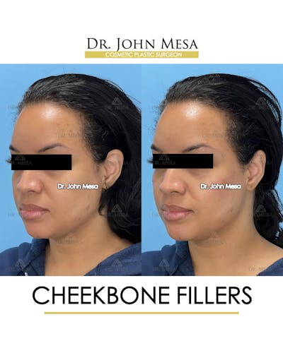 Cheekbone Filler Before & After Gallery - Patient 149097955 - Image 4