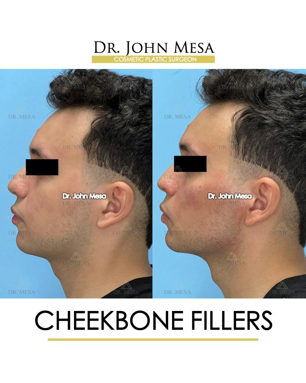 Cheekbone Filler Before & After Gallery - Patient 149097961 - Image 5