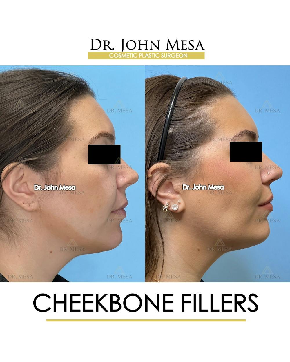 Cheekbone Filler Before & After Gallery - Patient 149097957 - Image 3