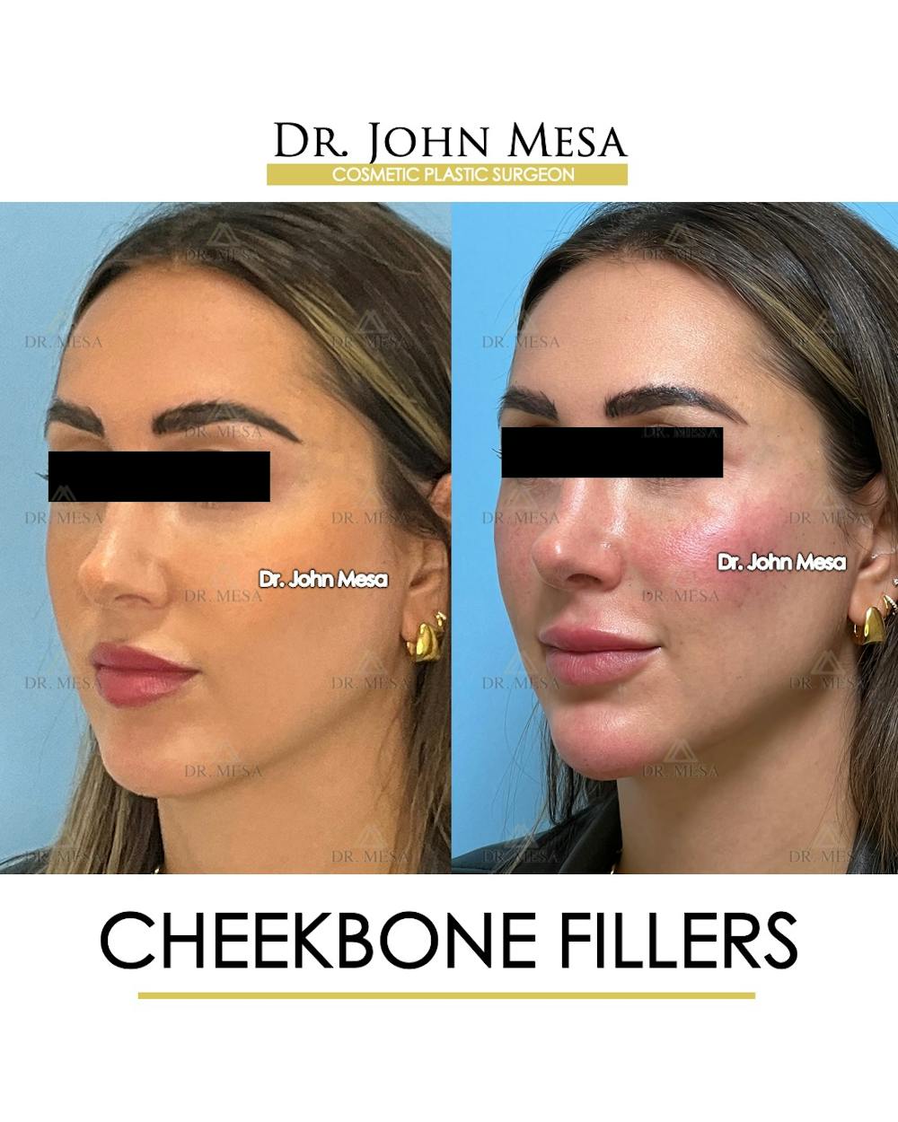 Cheekbone Filler Before & After Gallery - Patient 149097956 - Image 3
