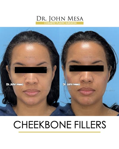 Cheekbone Filler Before & After Gallery - Patient 149097955 - Image 1