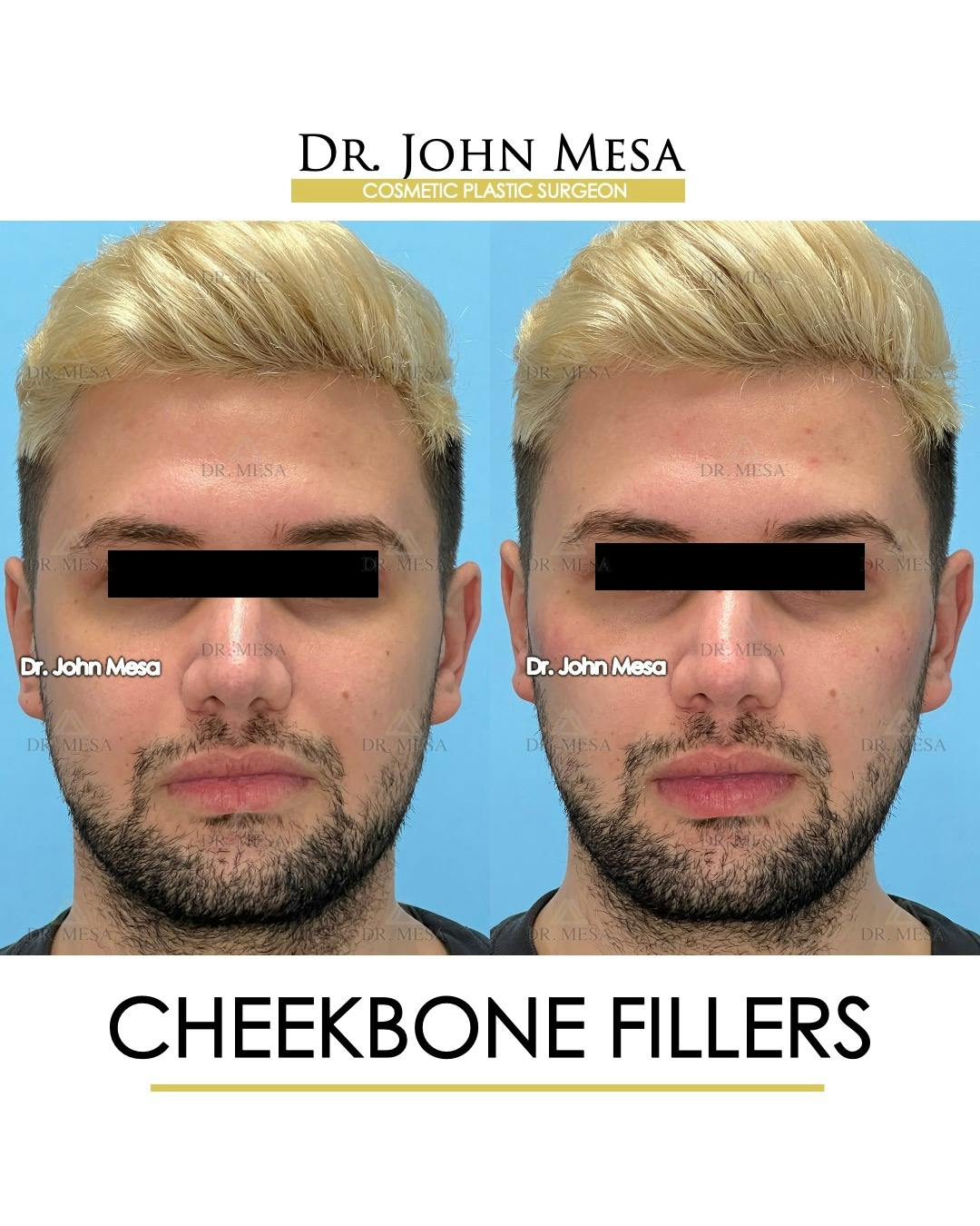 Cheekbone Filler Before & After Gallery - Patient 149097960 - Image 1