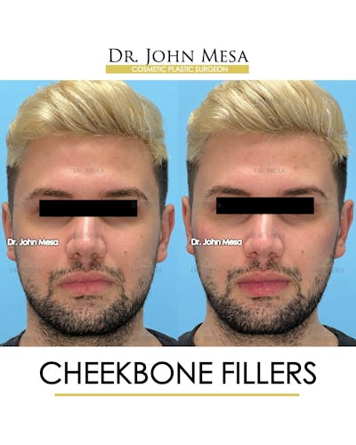 Cheekbone Filler Before & After Gallery - Patient 149097960 - Image 1