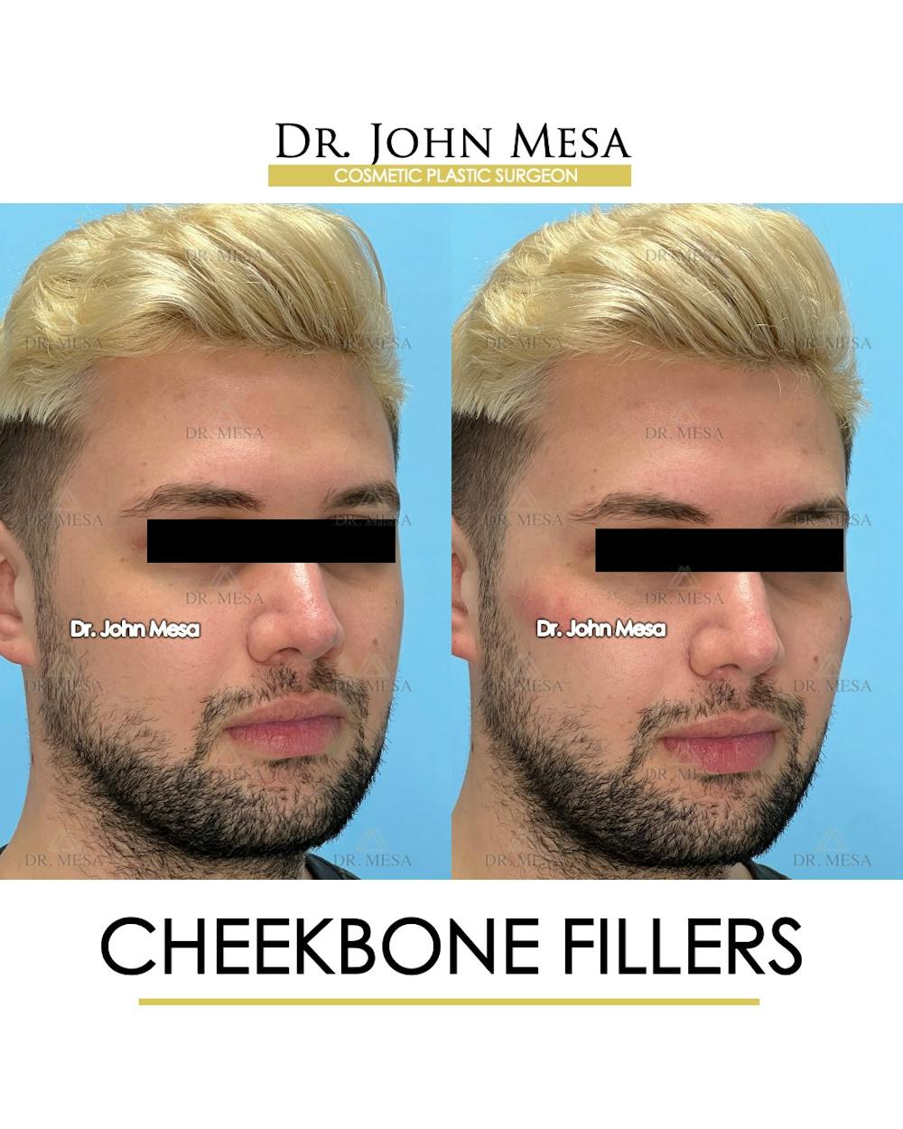 Cheekbone Filler Before & After Gallery - Patient 149097960 - Image 2