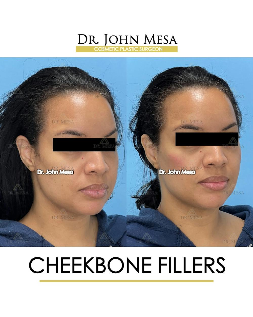 Cheekbone Filler Before & After Gallery - Patient 149097955 - Image 2
